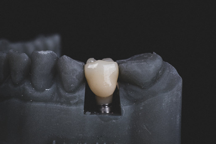 A dental crown, expertly crafted by a Dallas dentist, fitted on a model of teeth against a black background.