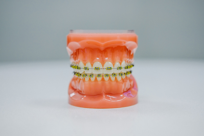 Dental model with braces on display at a Dallas dental clinic.