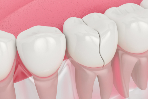 3D illustration of human teeth with one tooth slightly out of alignment in a Dallas dental office.
