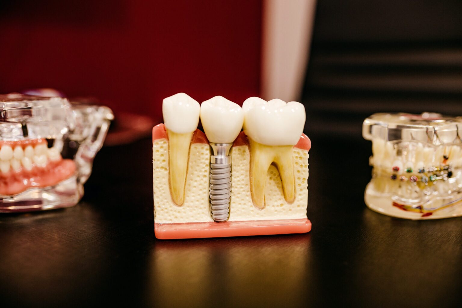 Dental implant model displaying a cross-section of tooth replacement with surrounding teeth and jawbone in a Texas dentistry clinic.