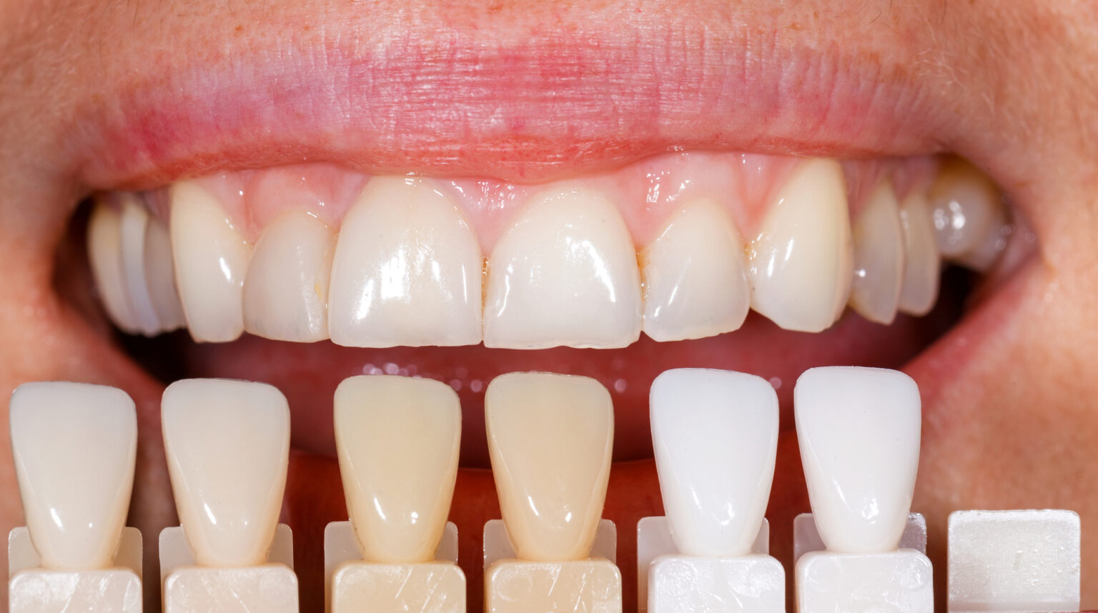 Close-up of a person's teeth being compared with a dental shade guide at a dental clinic.