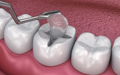 Dallas Dentists Explore the Wonderful World of Dental Fillings