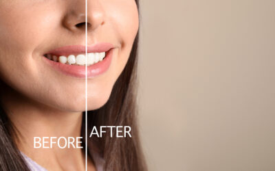Why You May Need Gum Contouring For Esthetics And Restorations