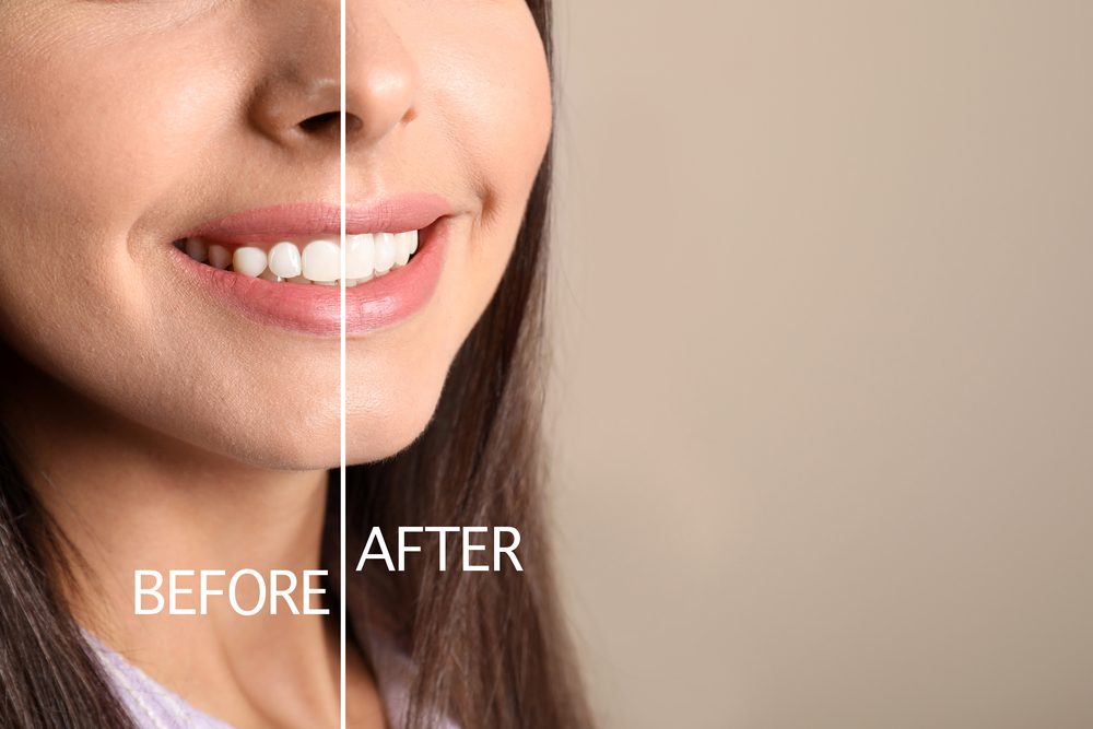 Teeth whitening results shown on a split-screen comparison of a woman's smile before and after treatment at an affordable Dallas dental clinic.