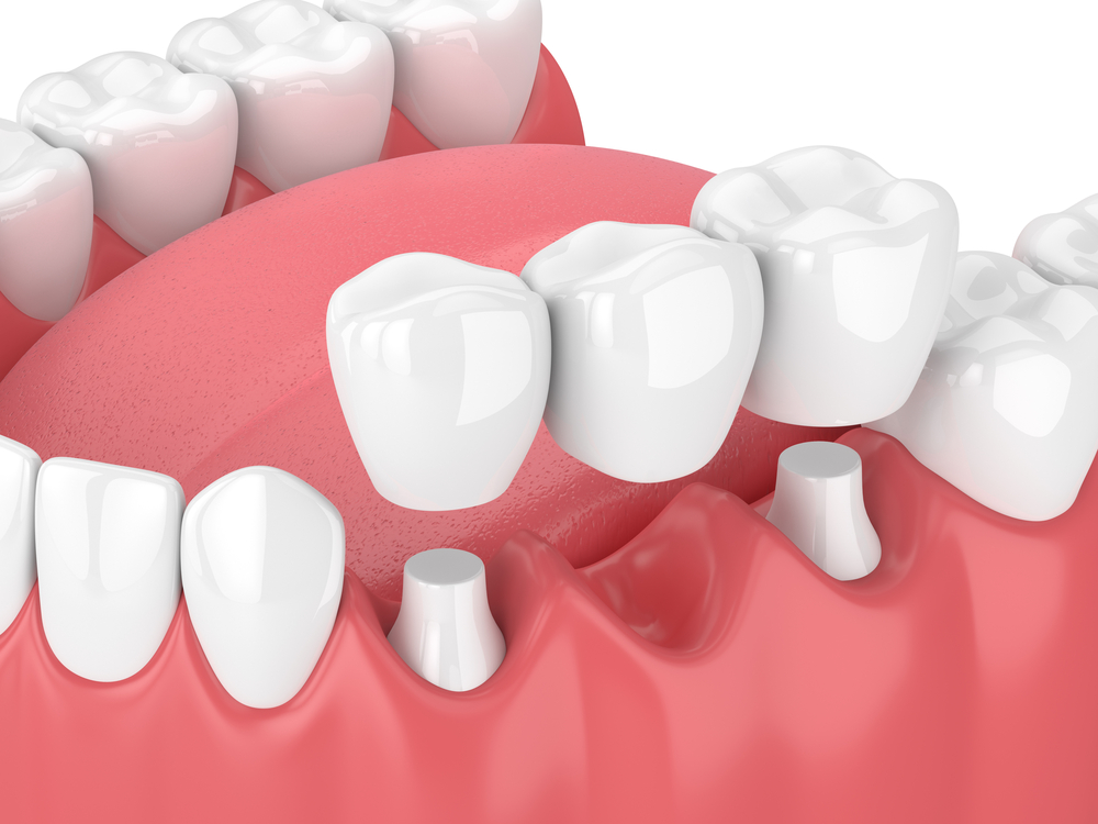 3D illustration of a dental bridge being placed on human teeth at a Texas dentistry clinic.
