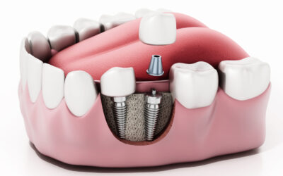 Dallas Dentists Debunk Top 10 Myths About Dental Implants