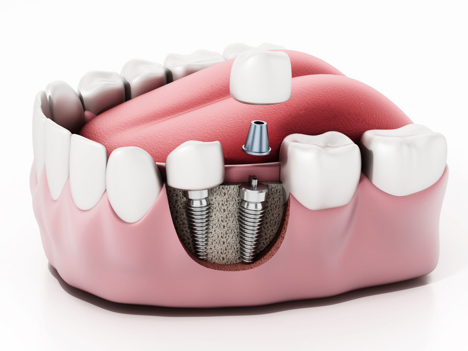 3d illustration of a dental implant in a jawbone with an exposed view showing the screw, abutment, and crown by a Dallas dentist.