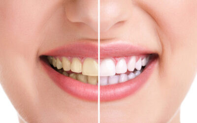 Cosmetic Dentistry Solutions for Common Smile Flaws