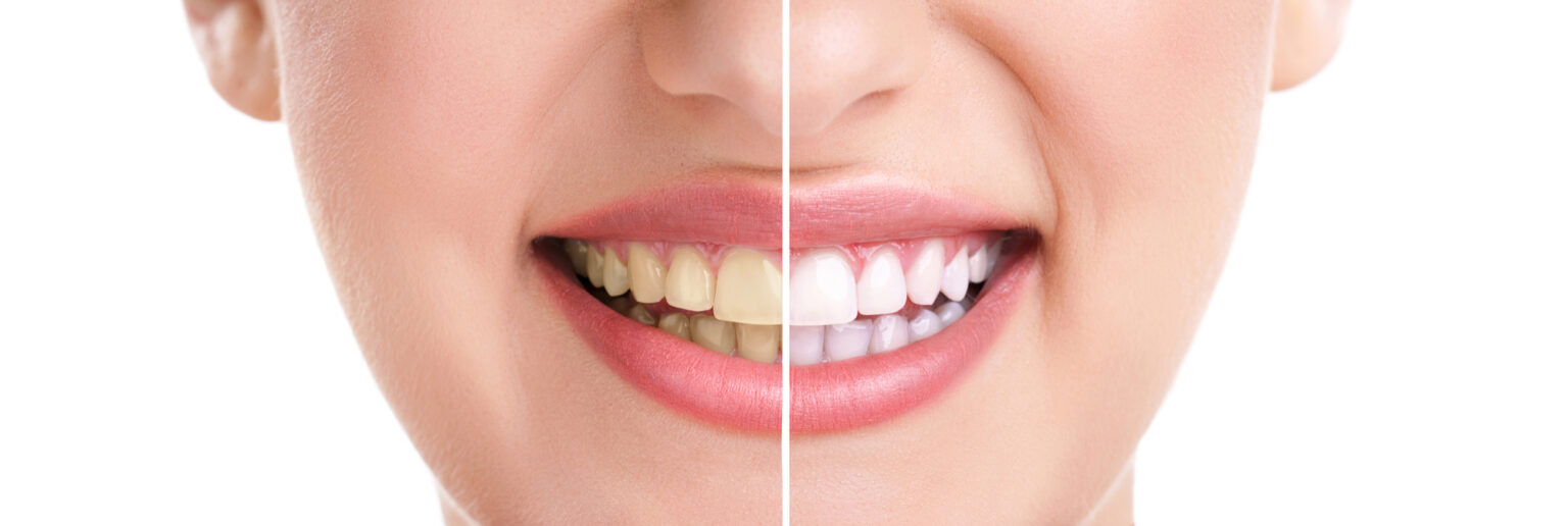 Before and after teeth whitening comparison by an affordable Dallas dentist.