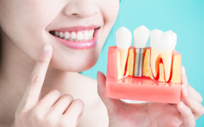The Do’s and Don’ts of Dental Implants