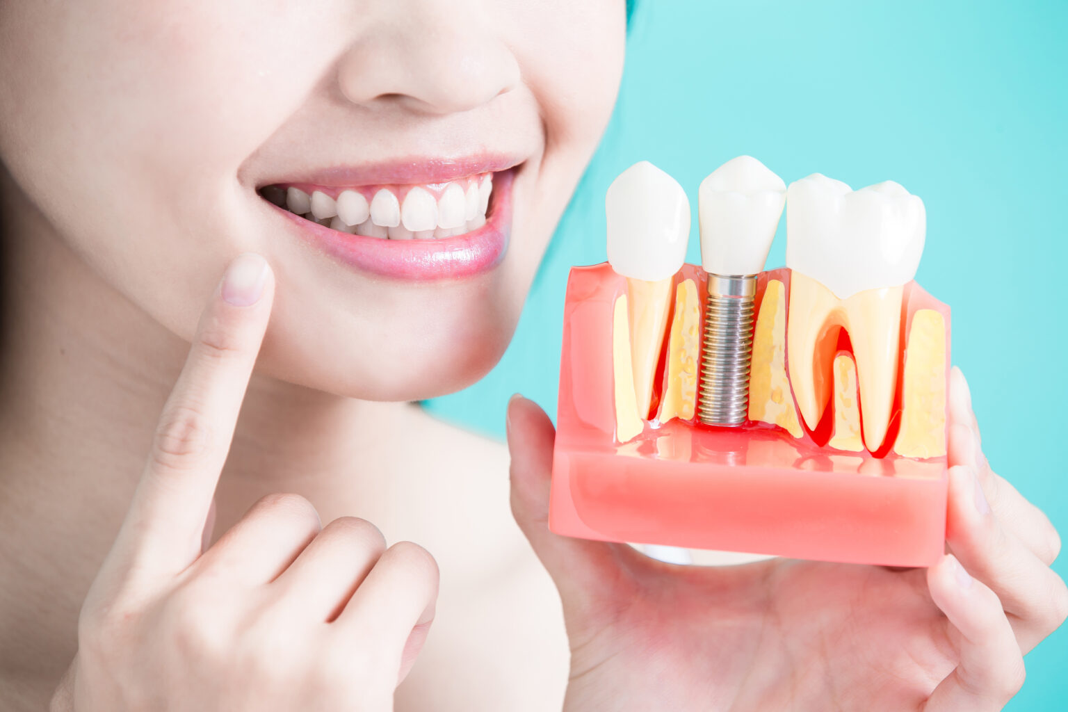 Woman pointing to her smile, holding a dental implant model in a dental clinic.