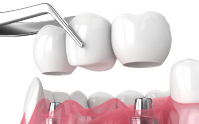 Answers to A Dozen Questions About Dental Bridges