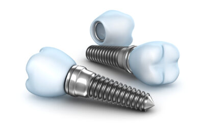 20 Astonishing Facts About Dental Implants