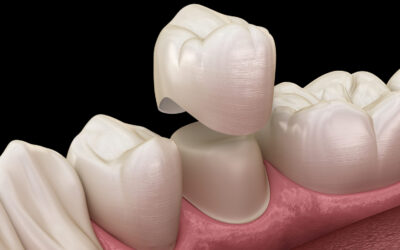 Dental Crowns vs. Cavity Fillings: Which is better?