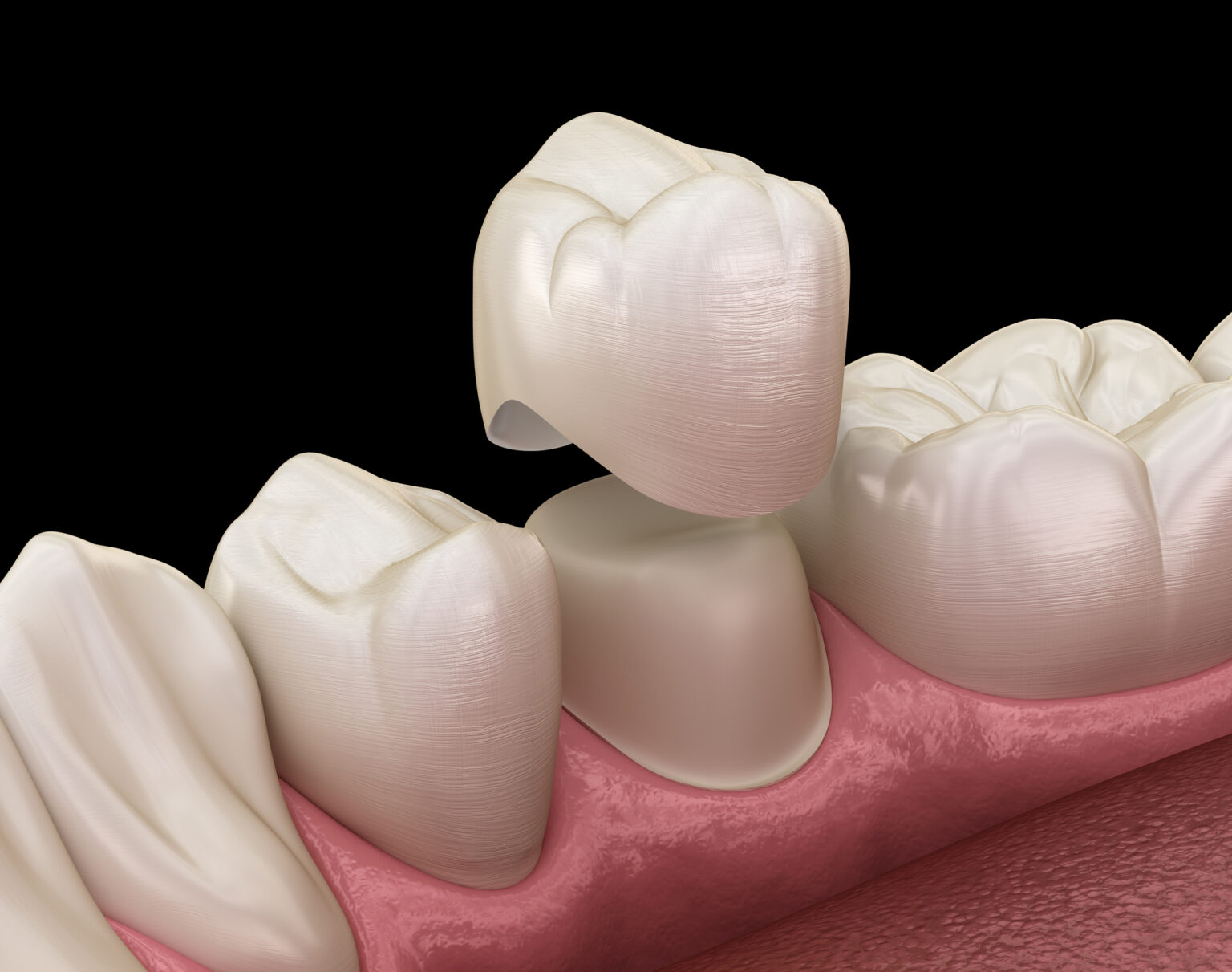 3d illustration of an affordable Dallas dentist placing a dental crown on a lower premolar tooth.