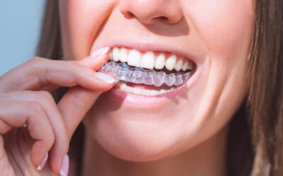 Interested in Invisalign®? Here are 8 benefits to consider.