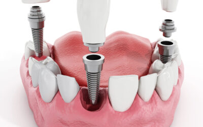 Weighing the Pros and Cons: Dental Implants vs. Traditional Dentures