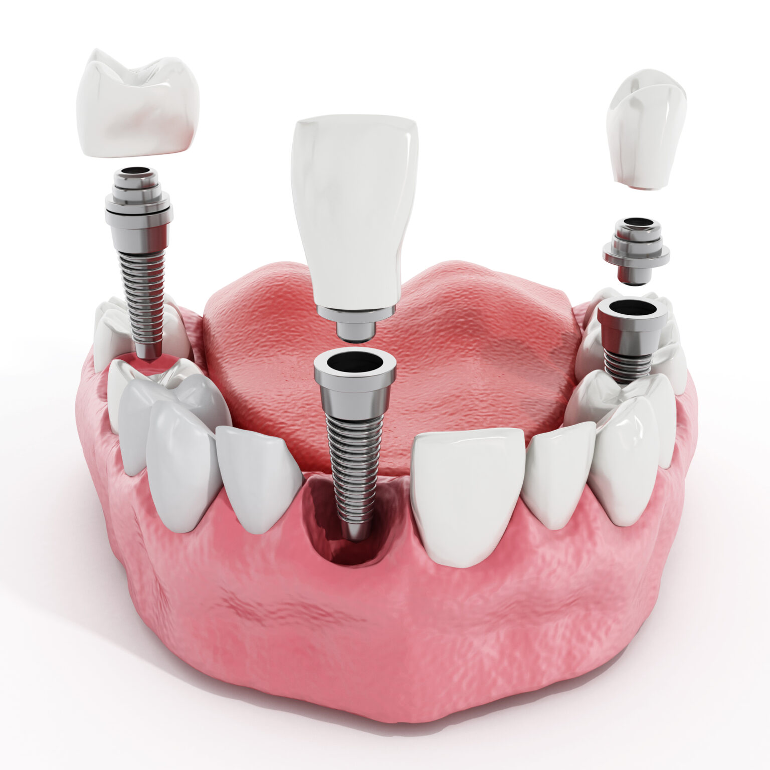 3d illustration of a dental implant procedure by an affordable Dallas dentist, showing implant posts, abutments, and crowns next to natural teeth on a gum model.