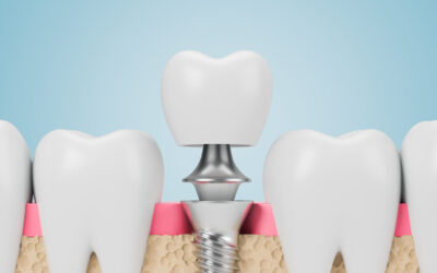 Find The Answers To Your Dental Implants Questions Here!
