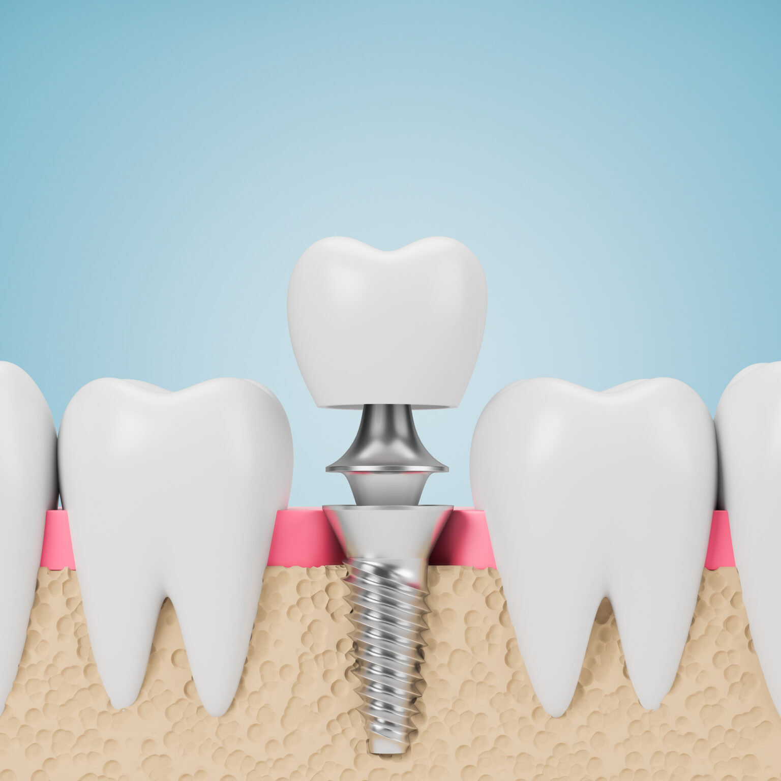 Dental implant between natural teeth against a blue background by an affordable Dallas dentist.