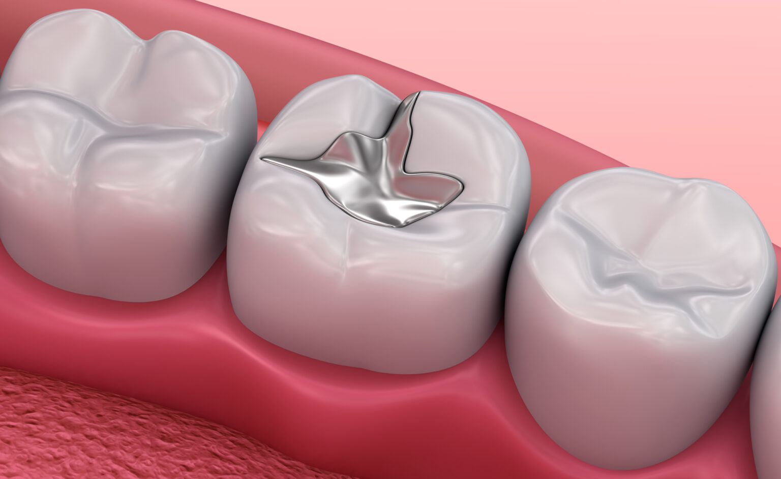 A 3D render of a dental amalgam filling on a molar tooth at an affordable Dallas dentist.