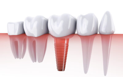 Experienced Dallas Dentists Unveil the Wonders of Dental Implants