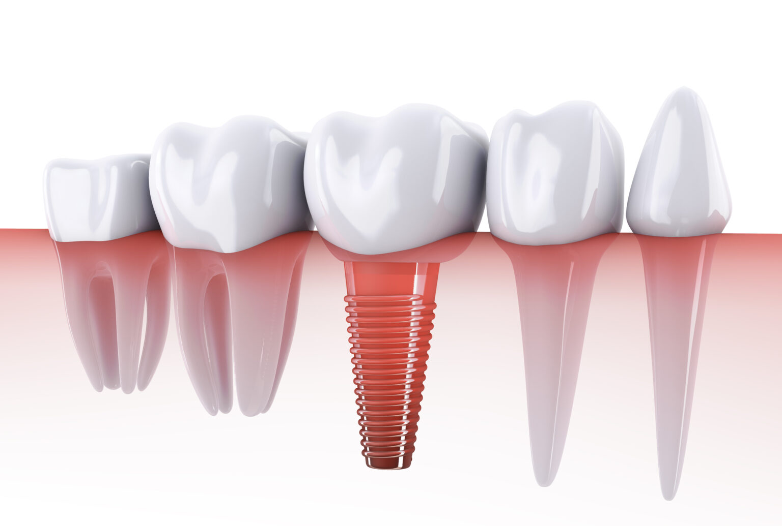 Dental implant surrounded by natural teeth shown in a cross-sectional view at an affordable Dallas dental clinic.
