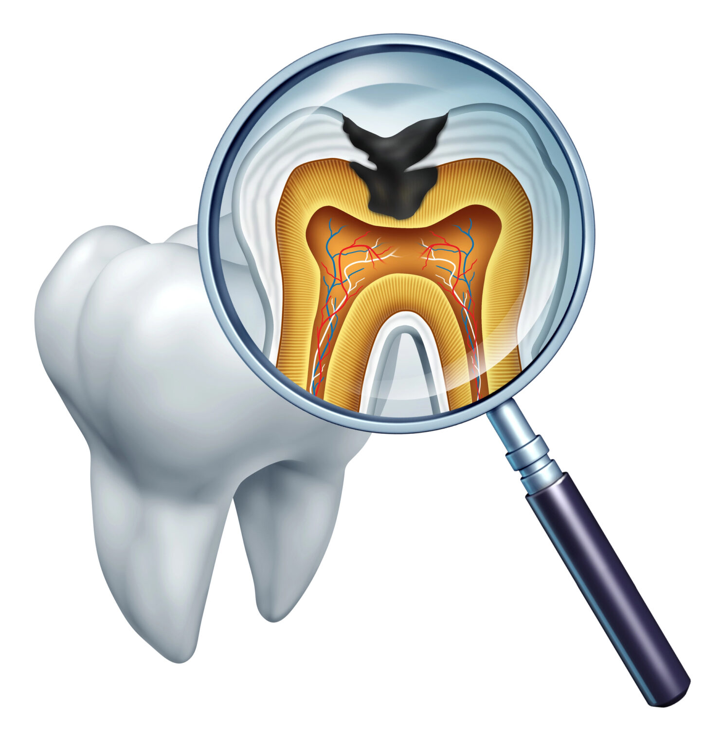 Illustration of a magnifying glass inspecting the anatomy of a tooth with a cavity, an example from an affordable Dallas dentist's dental clinic.