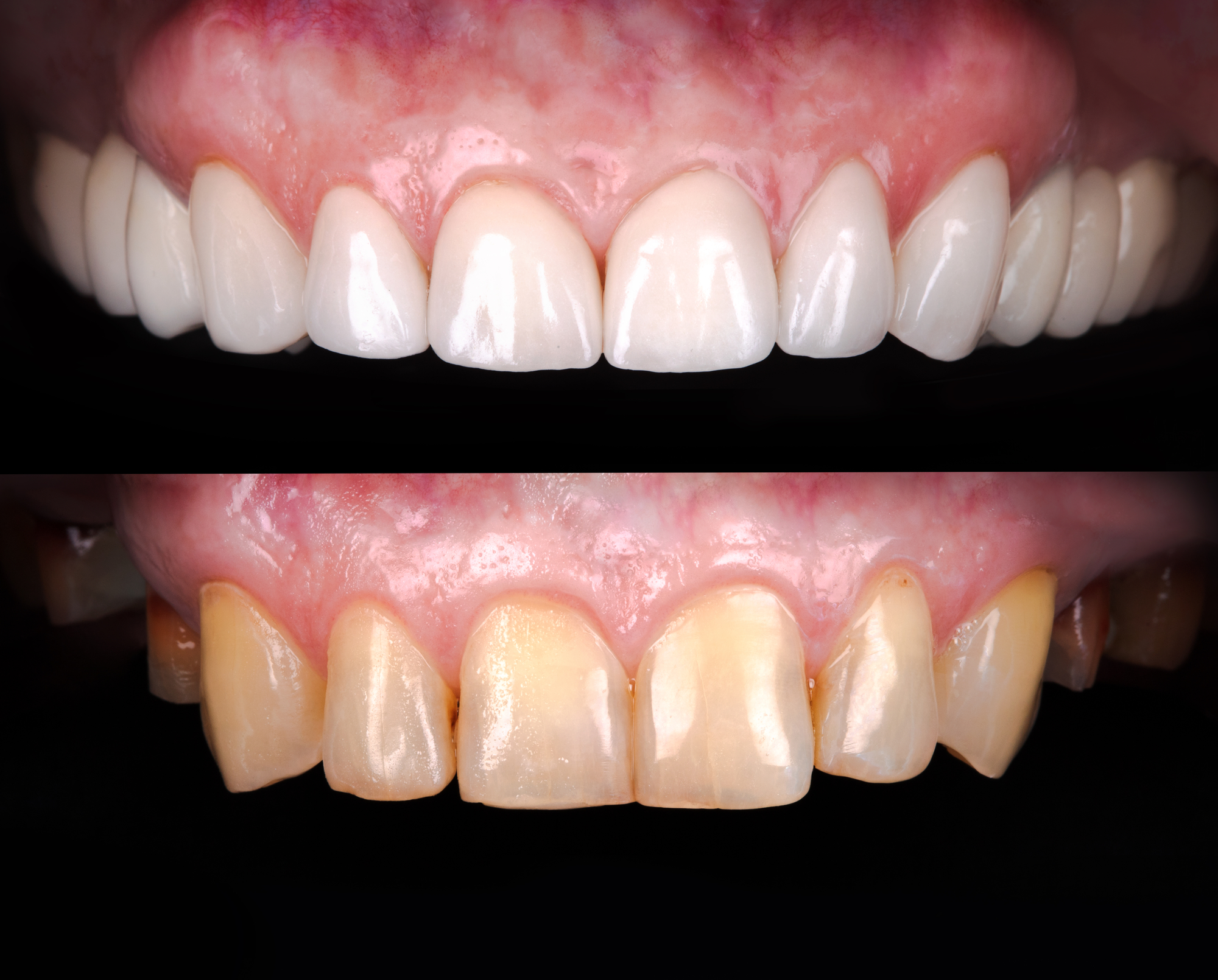 Comparison of two sets of teeth, top showing clean white teeth, bottom displaying stains on teeth.