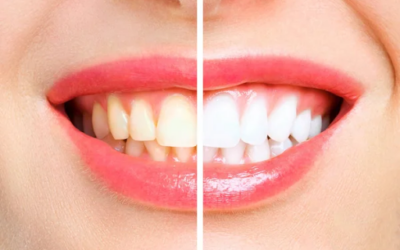DIY Teeth Whitening: What Works and What to Avoid