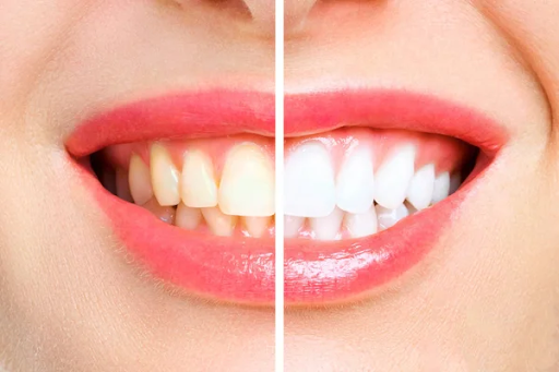 Side-by-side comparison of a smile: the left side displays slightly yellow teeth, while the right showcases brilliantly white teeth, highlighting the transformative results of teeth whitening.