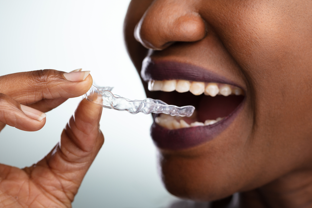 A person is holding and positioning a clear dental aligner near their open mouth, showing their teeth.