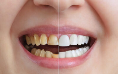 Cosmetic Dental Work for Busy People: What’s Possible in a Single Visit?