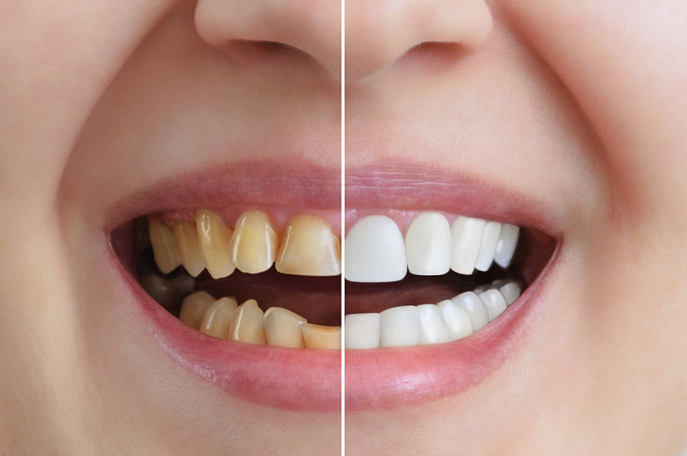 A split image showing a comparison of teeth before and after whitening. The left side features yellowed teeth, while the right side displays clean, white teeth, highlighting the effectiveness of teeth whitening.