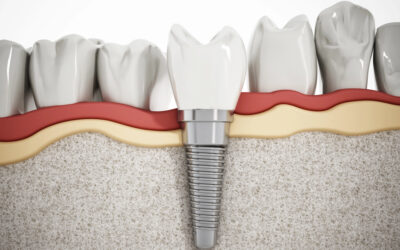 Can Anyone Get Dental Implants? 7 Factors That Make You a Good Candidate