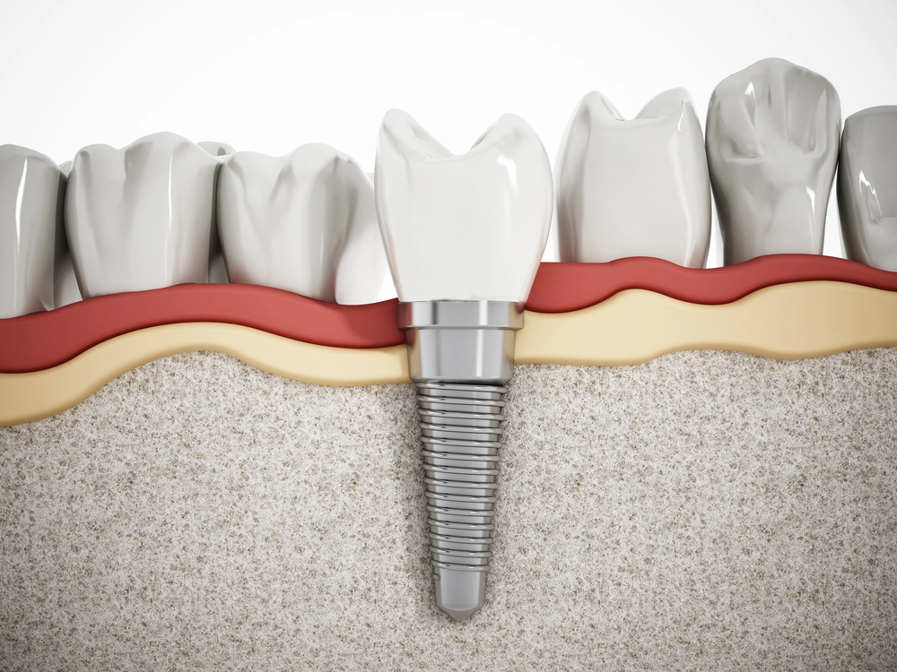 Cross-section illustration of a dental implant in the jawbone, showing the metal screw anchored in bone and topped with an artificial tooth, surrounded by natural teeth and gum tissue.