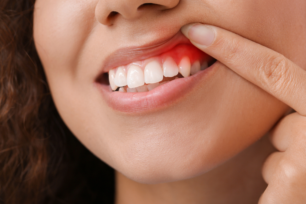 A close-up of a person lifting their upper lip to show red, swollen gums above their teeth, indicating gum inflammation or possible gingivitis.