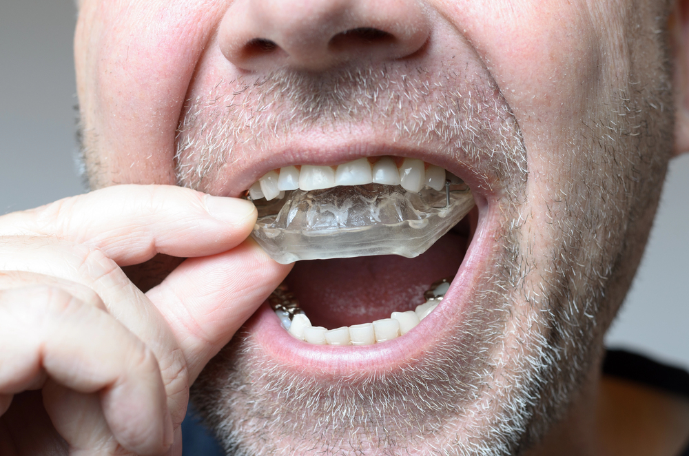 A close-up ofman wears nightguard to stop grinding and bruixism and dental damage a man’s face as he inserts a clear dental mouthguard over his upper teeth. His mouth is open, and his hand holds the mouthguard. The image highlights his teeth and facial stubble. man wears nightguard to stop grinding and bruixism and dental damage