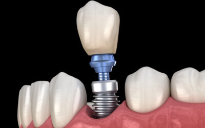 Why More Dallas Patients Are Choosing Dental Implants Over Traditional Tooth Replacement