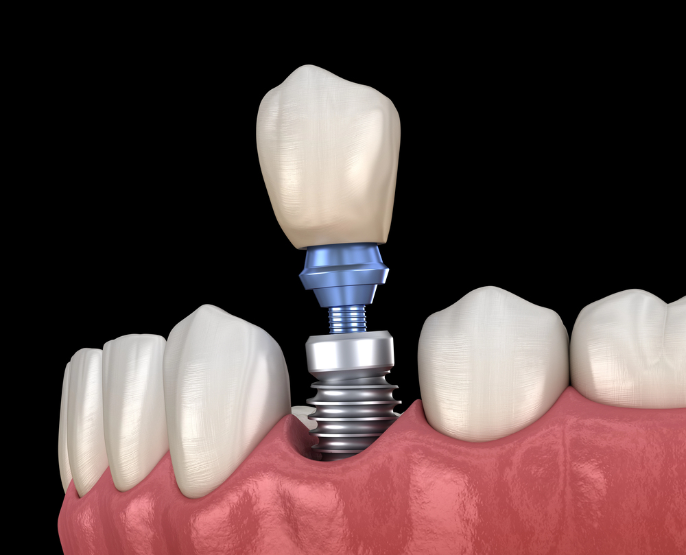 3d illustration of single dental implant in Dallas tx 3d illustration of single dental implant in Dallas tx