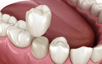 7 Ways Dental Crowns Save Teeth You Thought Were Beyond Repair