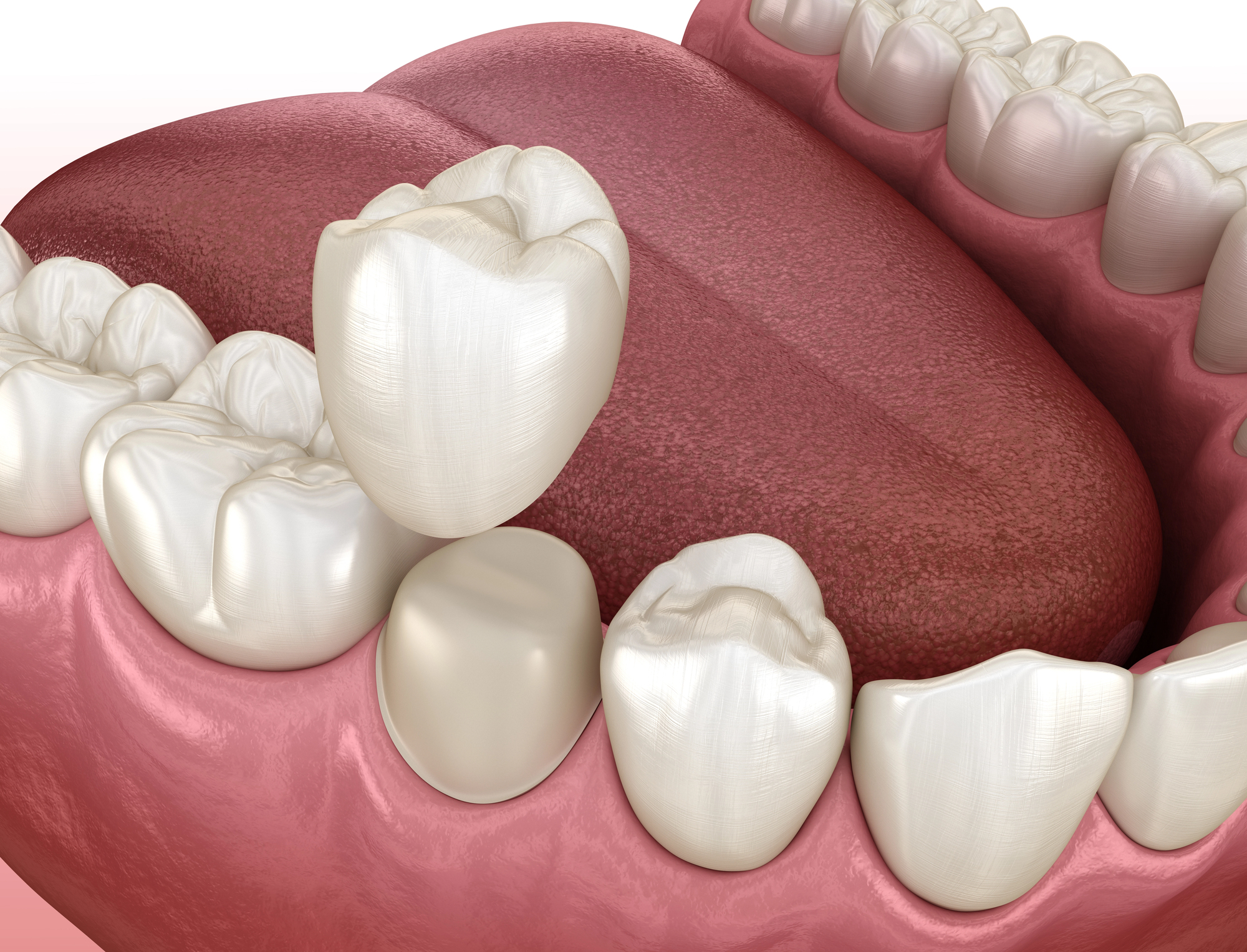 A 3D illustration of a human mouth showing a dental crown placed on a molar, with surrounding natural teeth, gums, and tongue visible.