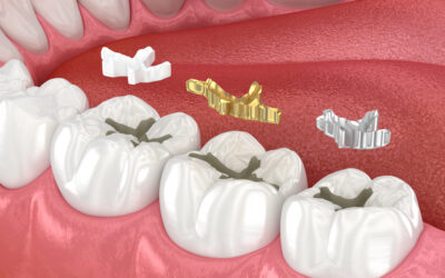 How Long Do Dental Fillings Last? Signs It’s Time for a Replacement