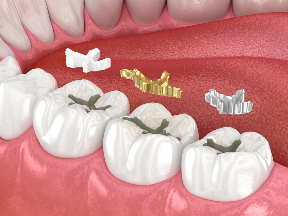 3D illustration of three molars with cavities, showing three types of dental inlays—white ceramic, gold, and silver—positioned above the teeth, ready for placement, with tongue and gums visible.